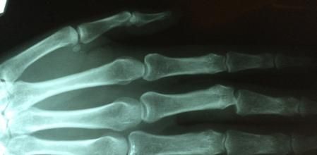 Construye su propia máquina de rayos X tras recibir una factura de 70.000 dólares del hospital