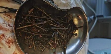 Esto es todo el que había en el estómago del hombre que comía trozos de hierro