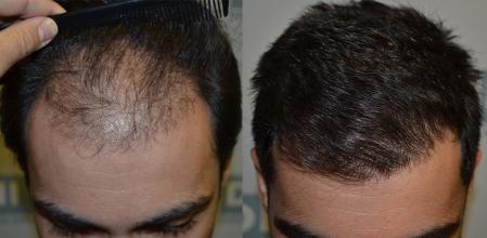 INJERTO CAPILAR ANTES Y DESPUES TRASPLANTE DE PELO TECNICA DHI DHI BARCELONA CLINICA