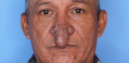 Conrado Estrada antes de someterse a la operación