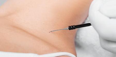 Intervención de una verruga en el cuello