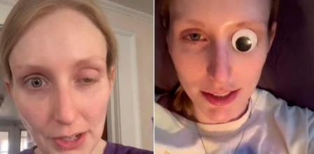 Una ‘tiktoker’ advierte de los peligros del bótox tras quedarse ciega de un ojo