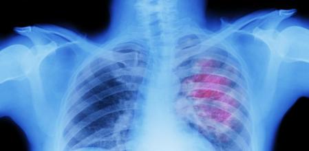 X-ray of lung showing chest cancer