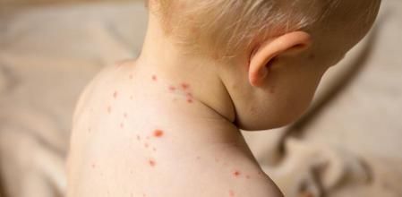 En el 2025 se habían confirmado 397 casos de sarampión de un total de 971 sospechosos