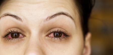 Mujer con conjuntivitis