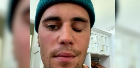 Justin Bieber ha pospuesto recientemente una serie de conciertos debido a una dolencia que le afecta directamente a la movilidad de parte de la cara. En un vídeo publicado en Instagram el cantante canadiense ha informado que retrasará más conciertos debido a una parálisis facial.