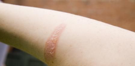 Quemadura de segundo grado