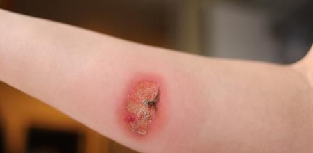 Quemadura de tercer grado