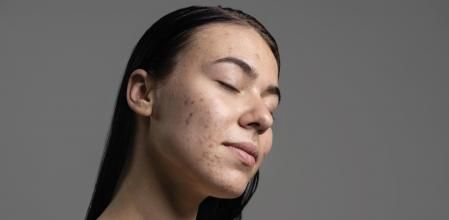 Cremas para eliminar el acné