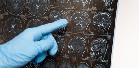 El dedo señala la imagen de un cerebro afectado por Alzheimer