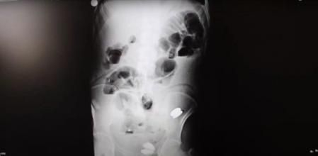 Va al médico por fuertes dolores en el abdomen y encuentran 233 objetos en el estómago