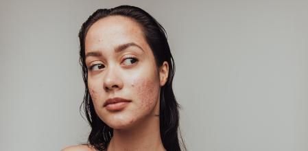 Acné quístico: qué es, por qué sale y cómo tratarlo en casa para eliminarlo lo antes posible