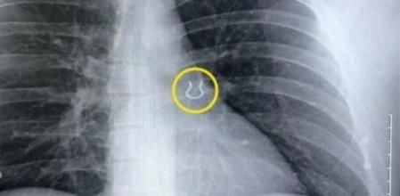 Un hombre descubre que tiene en el pulmón el piercing de la nariz que perdió hace 5 años
