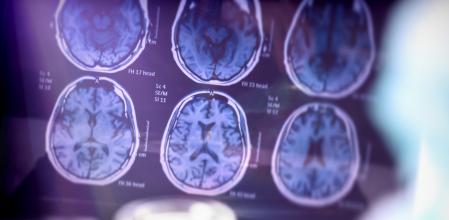 Scientific analysis of Alzheimer's disease in hospital, conceptual image