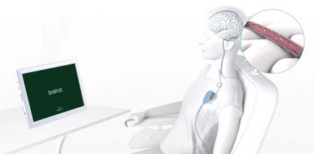 El Stentrode es un implante endovascular, colocado en una vena junto a la corteza motora que genera cualquier señal relacionada con el movimiento.