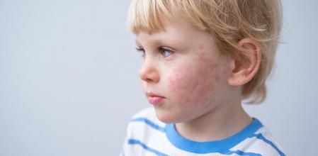 Un niño con manchas rojas n la cara a causa del frío