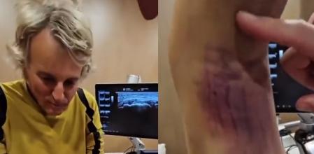 Jesús Calleja muestra las secuelas de su accidente de esquí