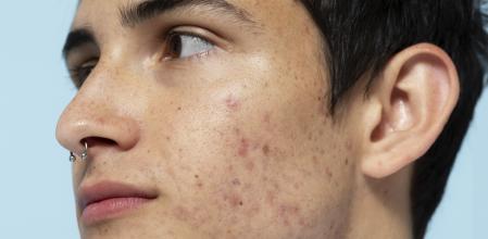 Una buena rutina de cuidado facial será fundamental.