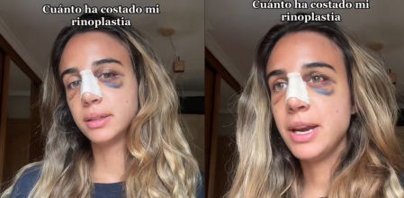 La rinoplastia cada vez es más popular
