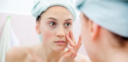 La genética puede influir en la presencia de ojeras en el rostro.