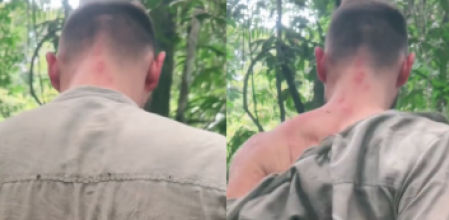 Germain enseña cómo le ha quedado la espalda