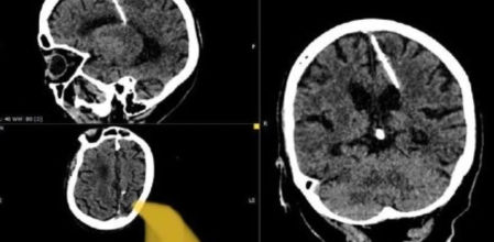 La aguja en el cerebro de la mujer