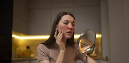 Cómo maquillar la piel que sufre rosácea.