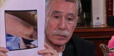 Marcos García Montes muestra los hematomas y lesiones de Daniel Sancho.