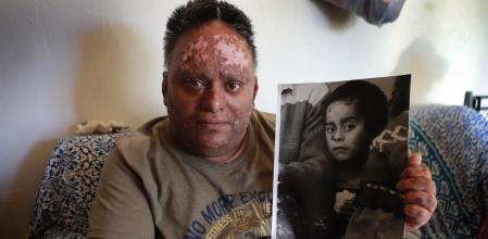 20-12.2023. Terrassa. Viriato de los Angeles tiene la enfermedad de Piel de Mariposa .© Foto: Cristóbal Castro