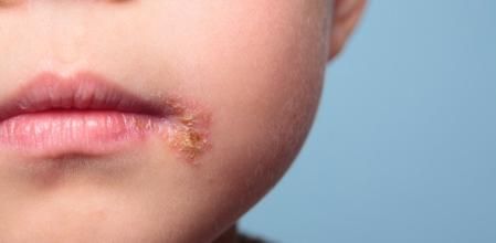 Impétigo, una infección bacteriana muy contagiosa