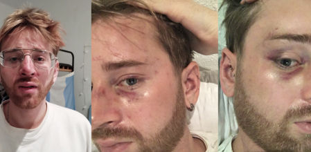 Un americano relata cómo le pegan una terrible paliza en Barcelona para robarle el móvil: “Me gritaron maricón”