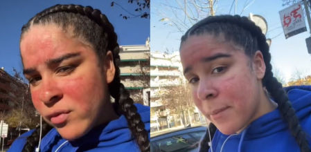 El calvario de María Botella, la joven profesora de natación que padece alergia al agua