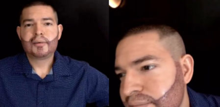 El resultado de un injerto de barba