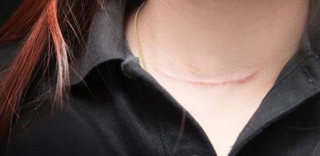 Cremas para eliminar las cicatrices