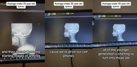 Un quiropráctico asegura que los millennials y las personas de la generación Z se están quedando jorobadas