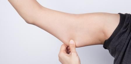 Una persona con flacidez en los brazos.