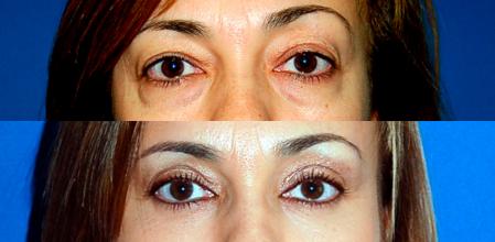 Con su técnica se corrigen las bolsas, el exceso de piel de los párpados superiores y se borran las ojeras