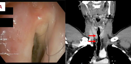 La imagen de la izquierda muestra pelo en la garganta: la de la derecha, el lugar en el que apareció el pelo.