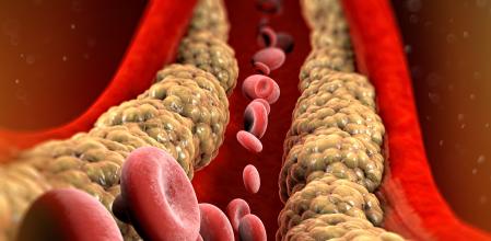 Formación de colesterol en las arterias