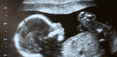 La pérdida de líquido amniótico es un gran riesgo en el embarazo