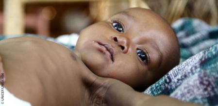 Baraa, de 6 meses, está acostado en una cama en su casa en Damazine, estado de Nilo Azul