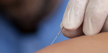 ¿Qué es la punción seca y para qué la usan los fisioterapeutas?