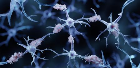 Acumulaciones de la proteína beta-amiloide (color rosado), características del alzheimer, entre neuronas