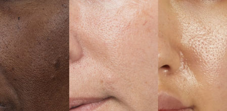 Los poros dilatados se pueden tratar con principios como la niacinamida y exfoliantes con BHA