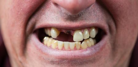 Un hombre al que le falta un diente