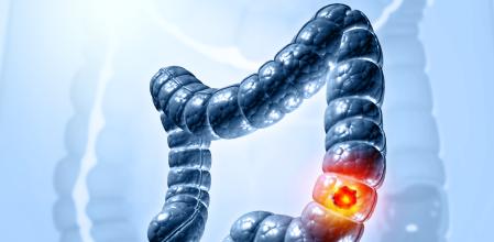 El cáncer de colon es uno de los que tienen más incidencia en España