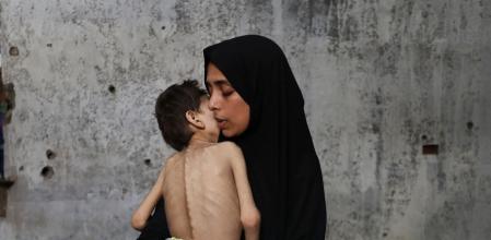 Una madre palestina en Gaza, con su hijo malnutrido y discapacitado&nbsp;