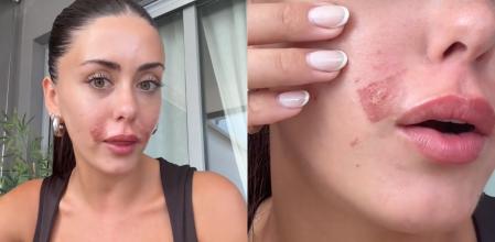 La 'influencer' Rosario Matew muestra las quemaduras sufridas tras el uso de las tiras de cera fría