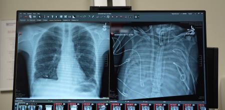 Radiografia del pacient sense pulmons connectat al sistema artificial (dr.) i un cop transplantat (esq.)