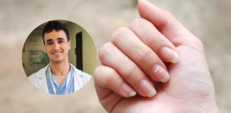 Alfredo García, doctor, sobre las manchas blancas en las uñas: ''Son microtraumatismos”